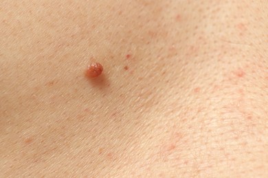 Photo of Man with mole on his skin, closeup