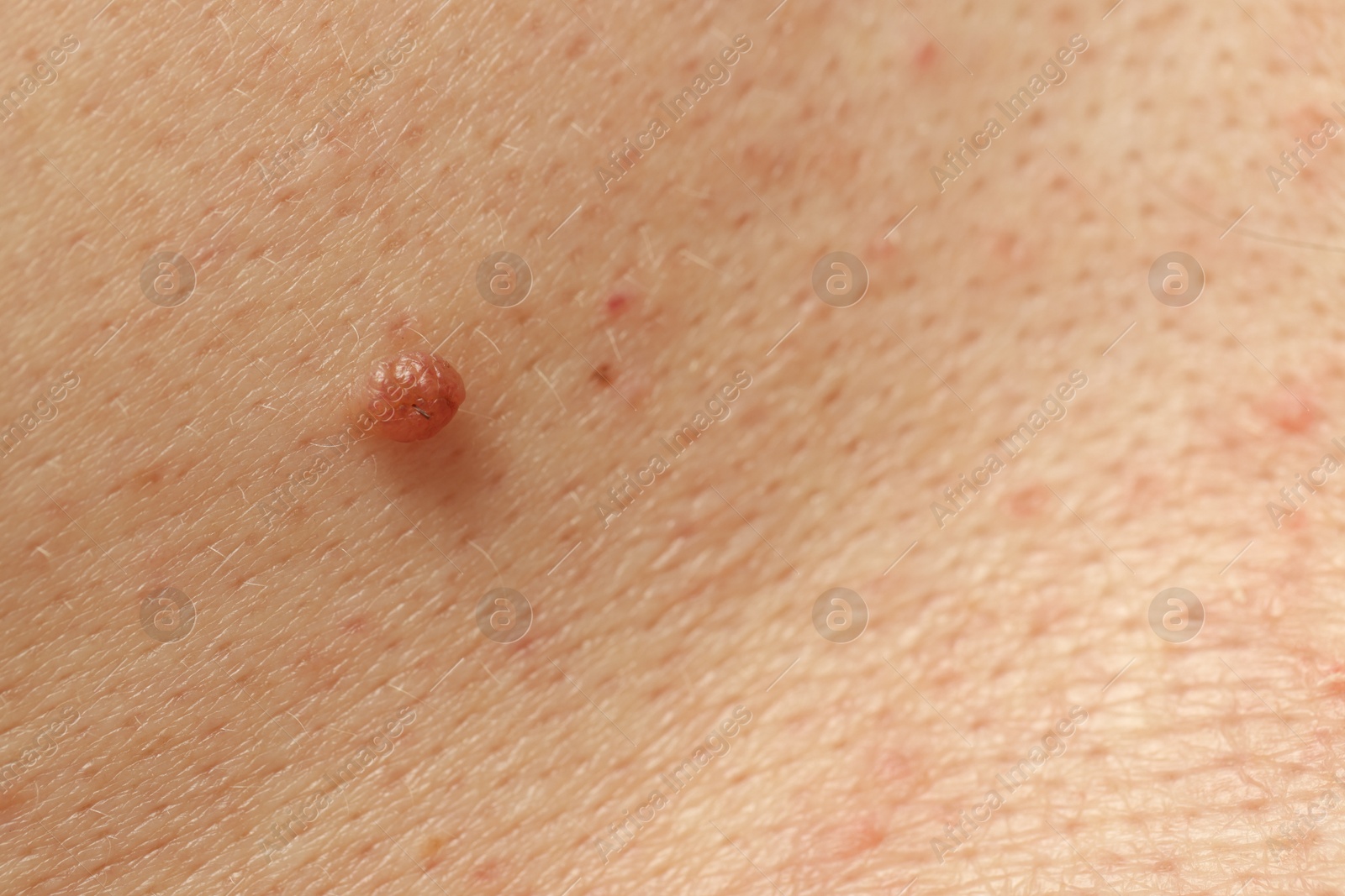 Man with mole on his skin, closeup Photo of Man with mole on his skin, closeup