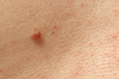 Photo of Man with mole on his skin, closeup