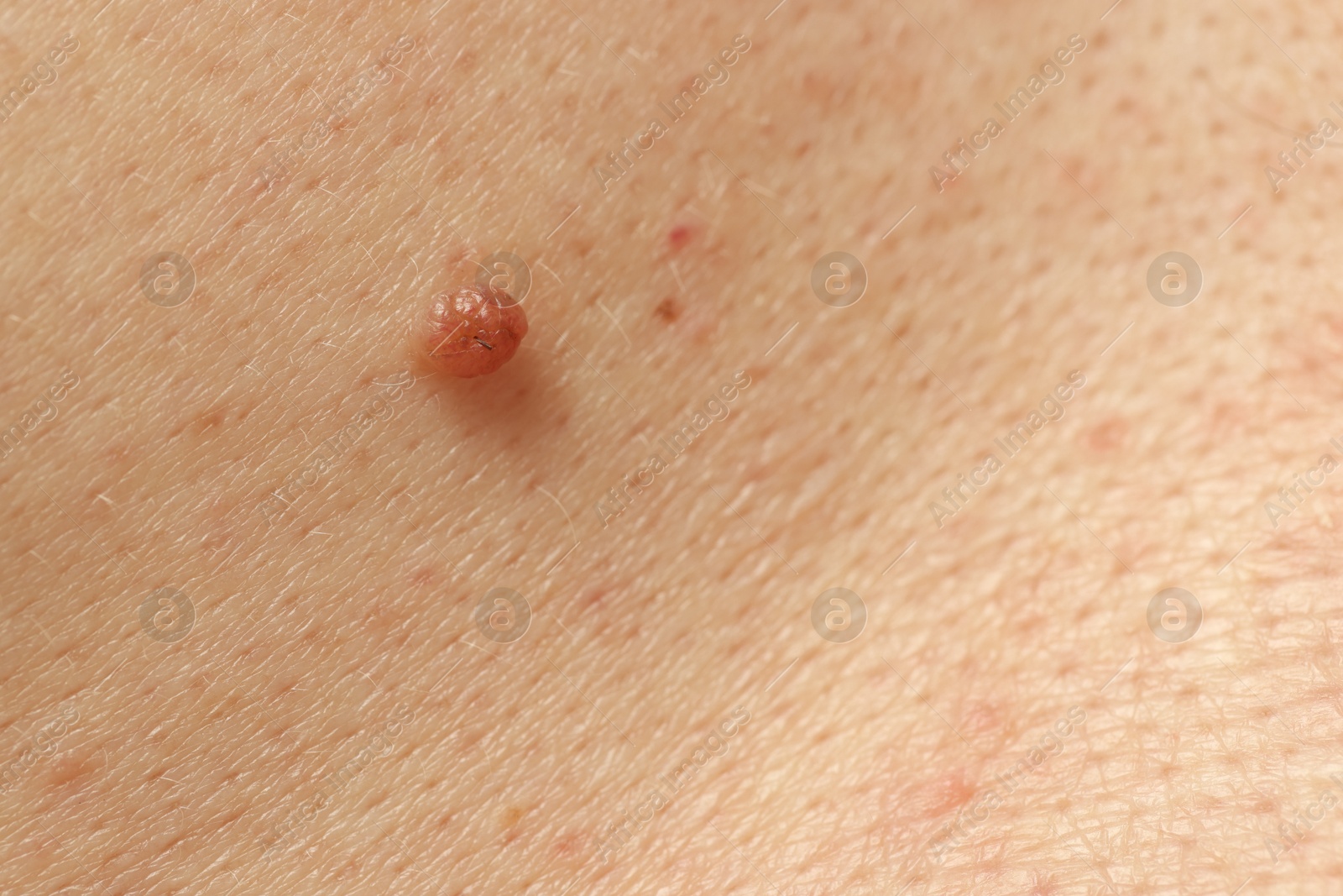 Man with mole on his skin, closeup Photo of Man with mole on his skin, closeup