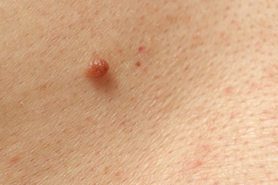 Photo of Man with mole on his skin, closeup