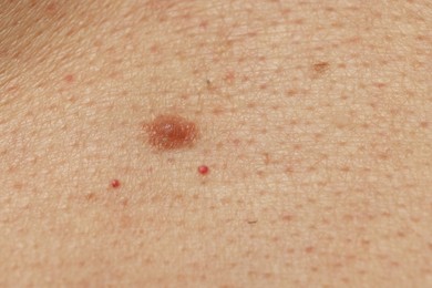 Photo of Man with mole on his skin, closeup