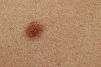 Photo of Man with mole on his skin, closeup