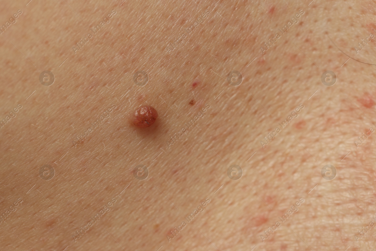 Man with mole on his skin, closeup Photo of Man with mole on his skin, closeup