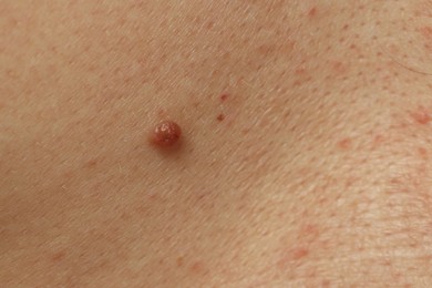 Photo of Man with mole on his skin, closeup