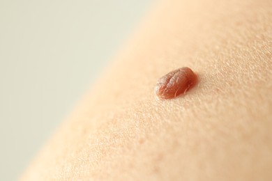 Photo of Man with mole on his skin against light background, closeup. Space for text