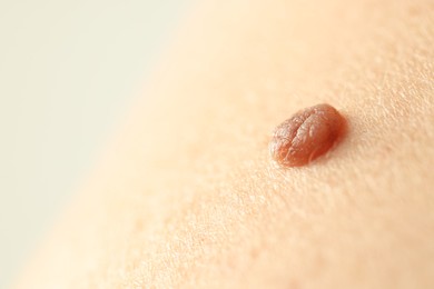 Photo of Man with mole on his skin, closeup. Space for text