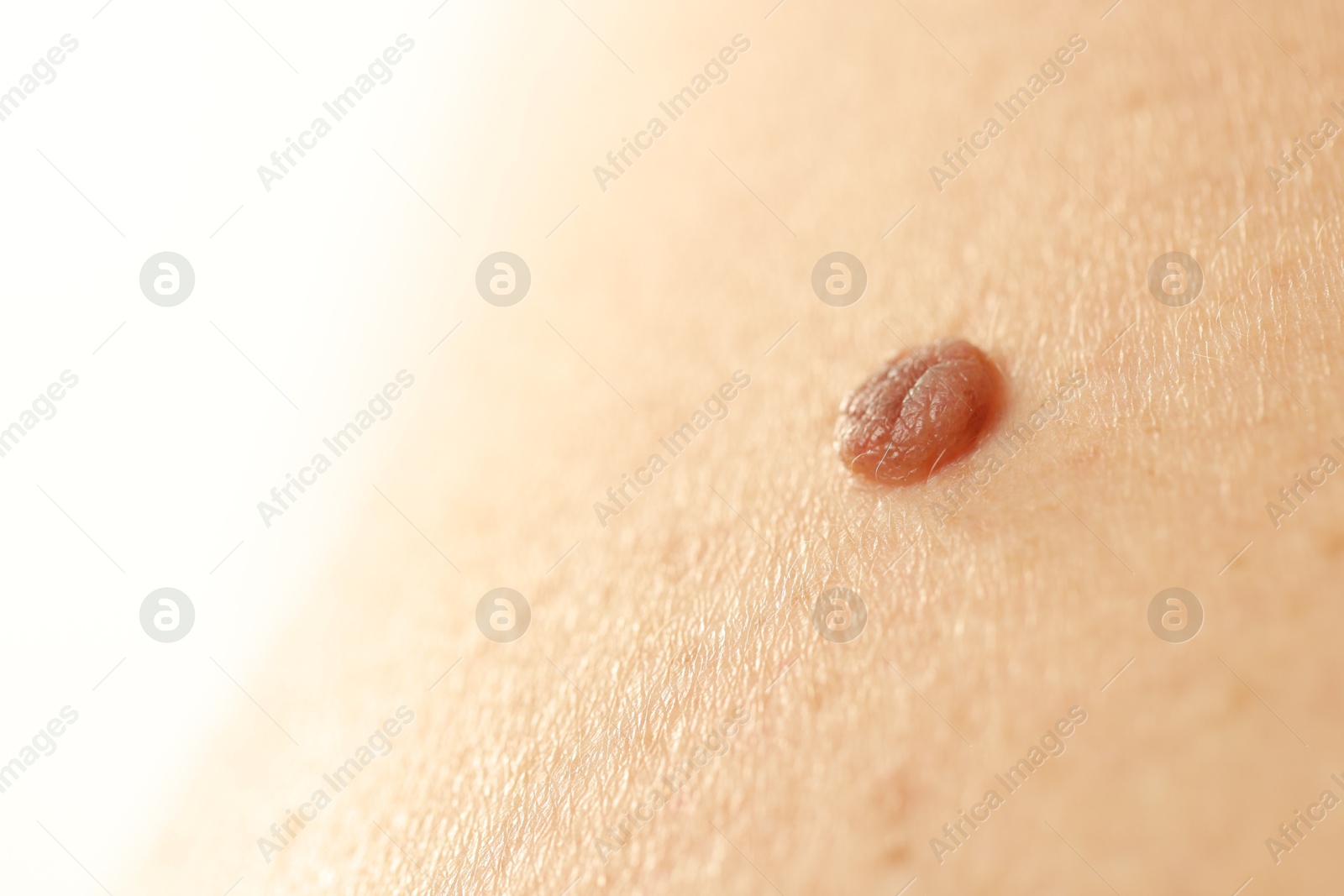 Man with mole on his skin, closeup. Space for text Photo of Man with mole on his skin, closeup. Space for text