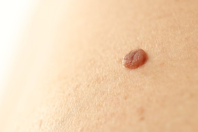 Photo of Man with mole on his skin, closeup. Space for text