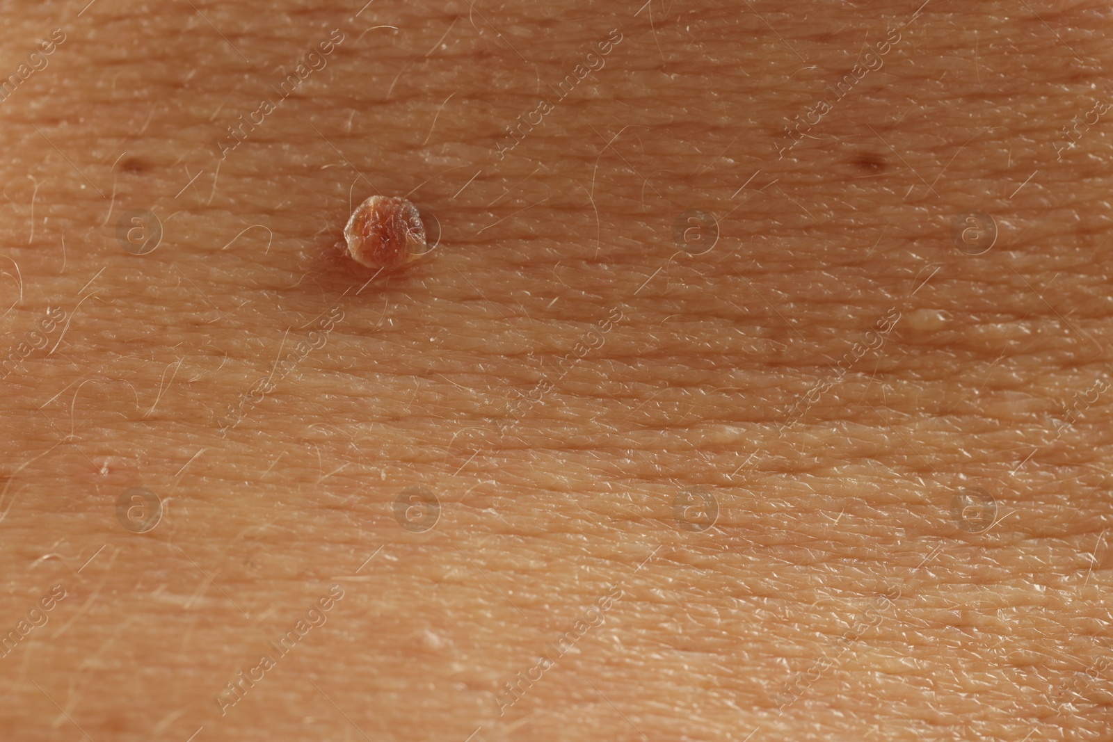 Man with mole on his skin, closeup Photo of Man with mole on his skin, closeup