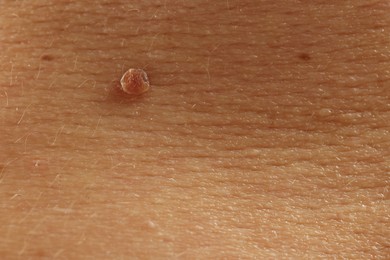 Photo of Man with mole on his skin, closeup