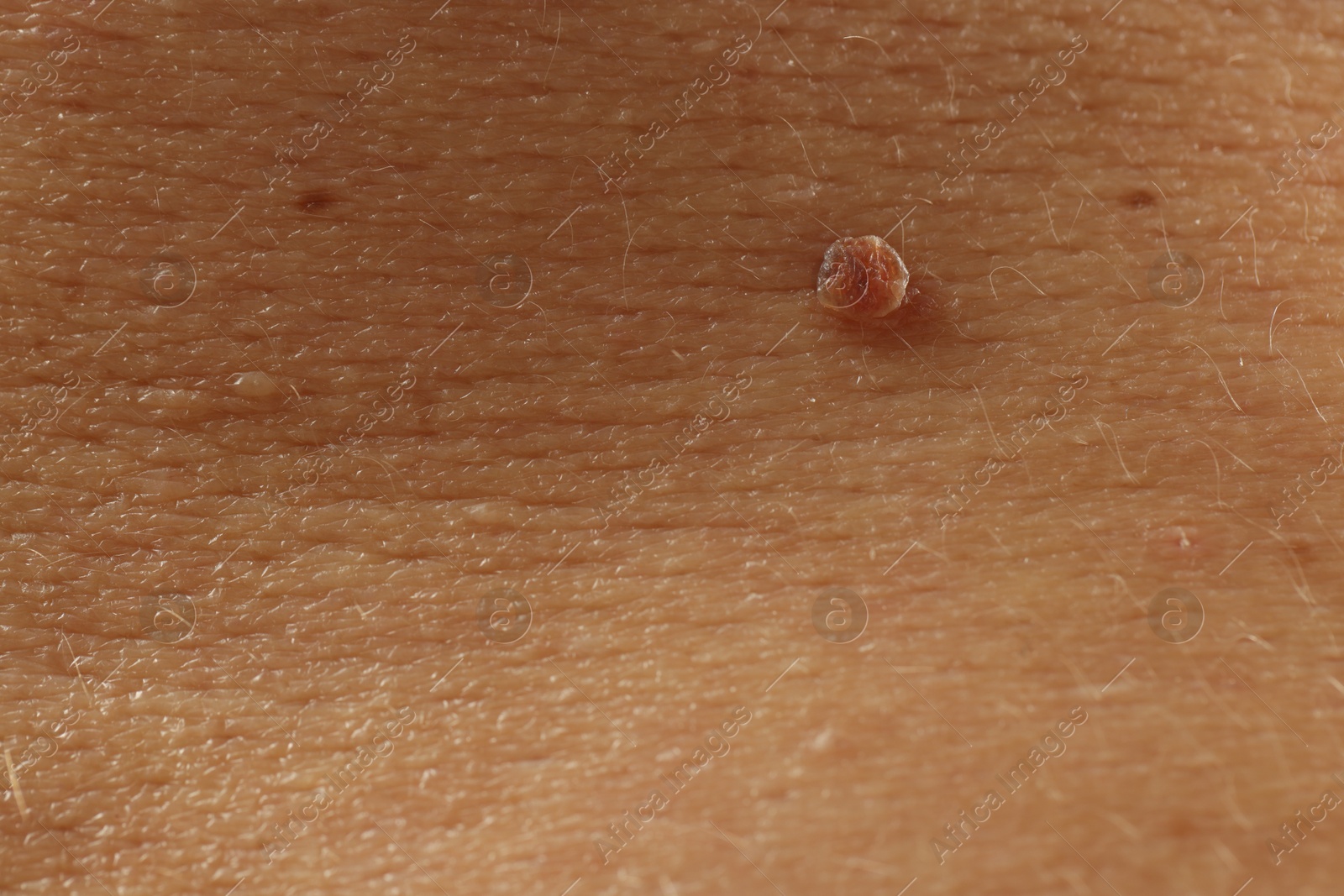 Man with mole on his skin, closeup Photo of Man with mole on his skin, closeup