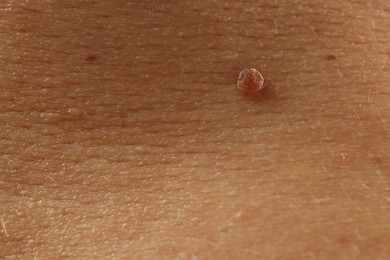 Photo of Man with mole on his skin, closeup