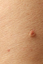 Photo of Man with mole on his skin, closeup