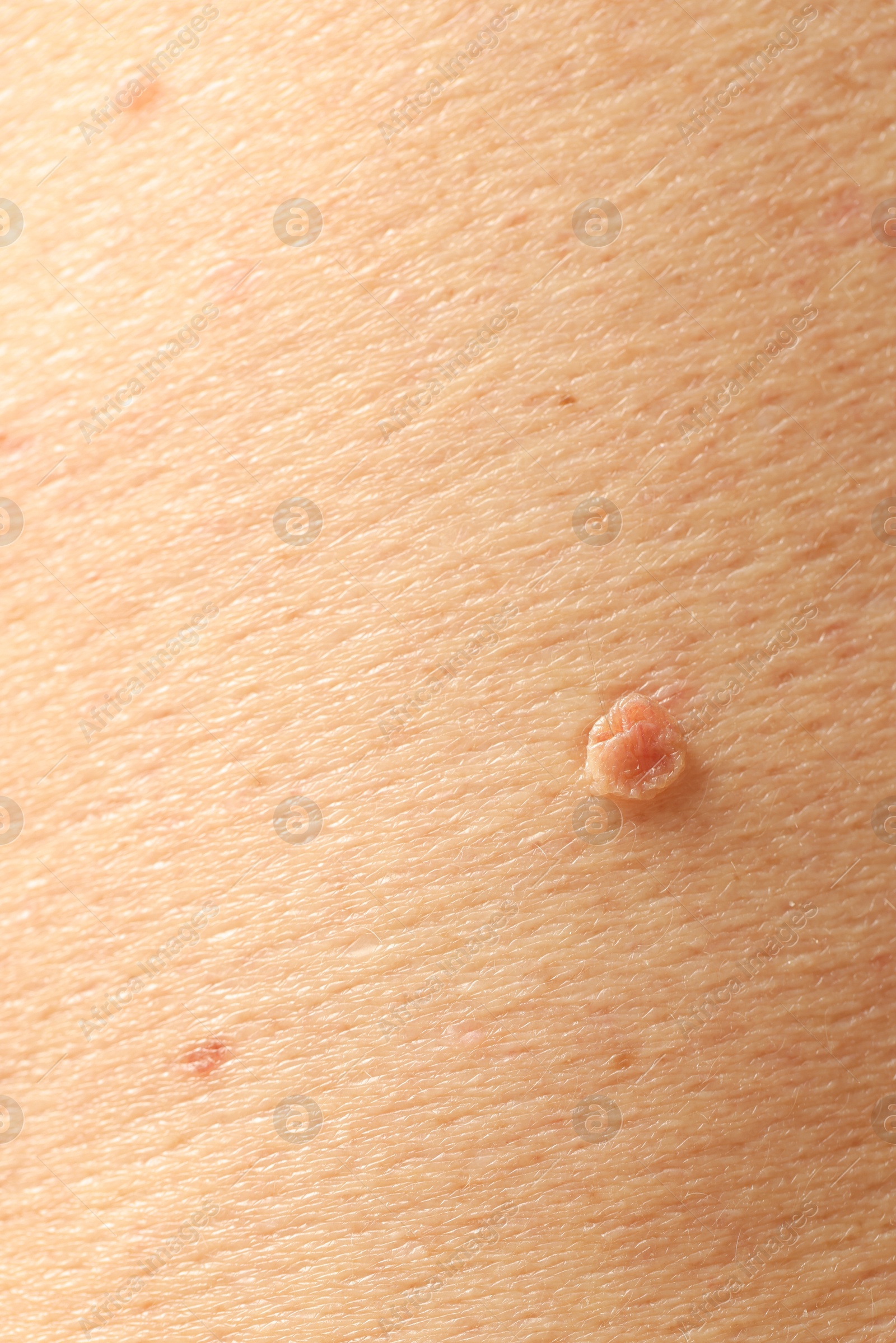 Man with mole on his skin, closeup Photo of Man with mole on his skin, closeup