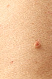 Photo of Man with mole on his skin, closeup