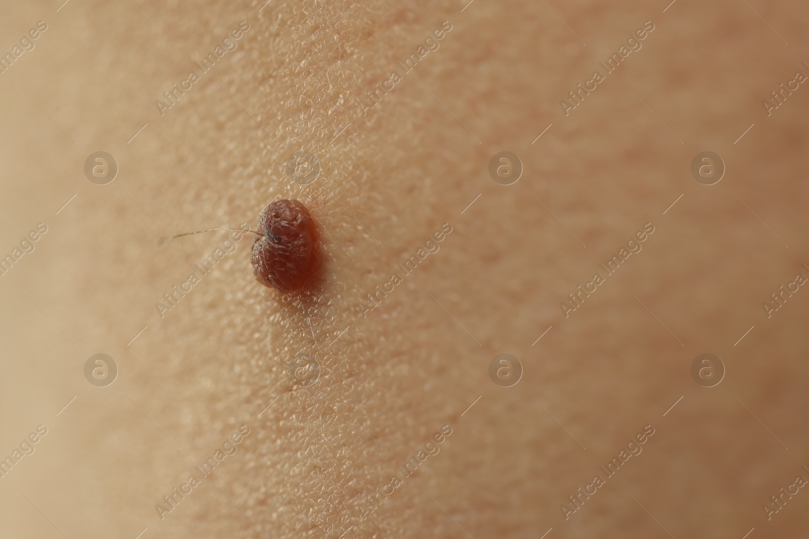 Man with mole on his skin, closeup Photo of Man with mole on his skin, closeup