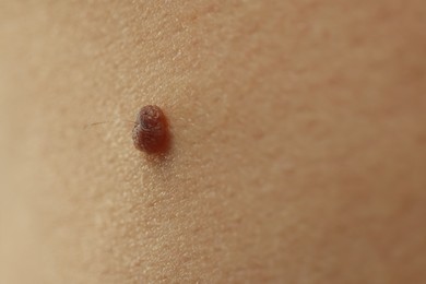 Photo of Man with mole on his skin, closeup