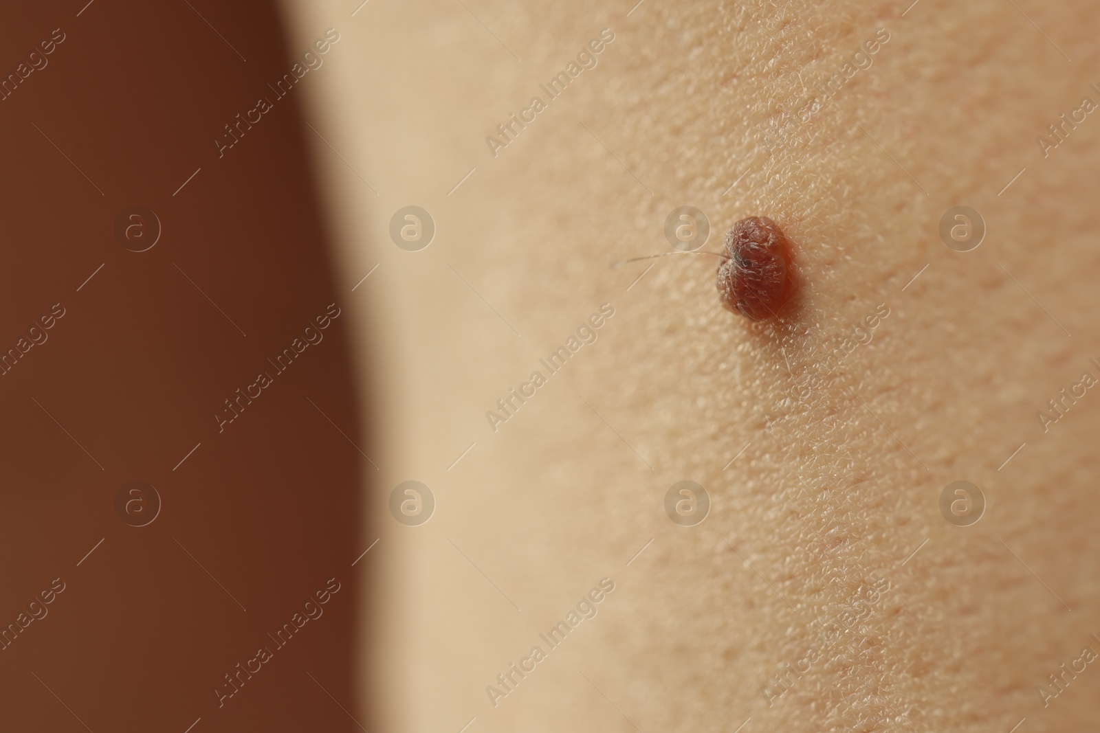 Man with mole on his skin against brown background, closeup. Space for text Photo of Man with mole on his skin against brown background, closeup. Space for text