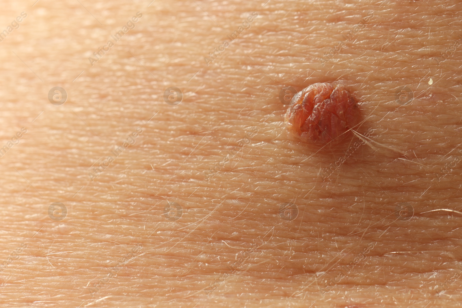 Man with mole on his skin, closeup Photo of Man with mole on his skin, closeup