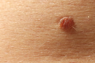 Photo of Man with mole on his skin, closeup