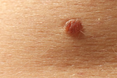 Photo of Man with mole on his skin, closeup