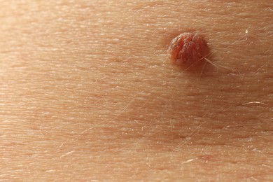 Photo of Man with mole on his skin, closeup