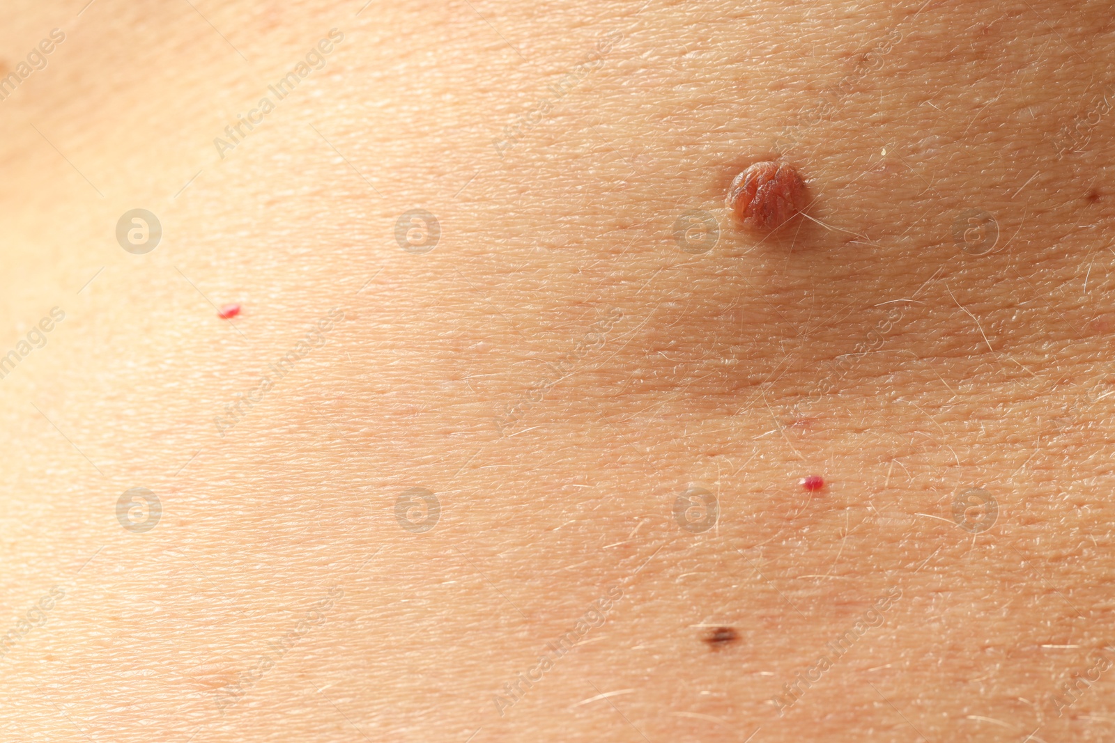 Man with moles on his skin, closeup Photo of Man with moles on his skin, closeup