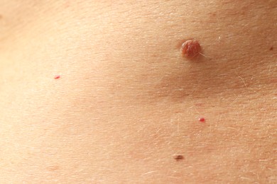 Photo of Man with moles on his skin, closeup