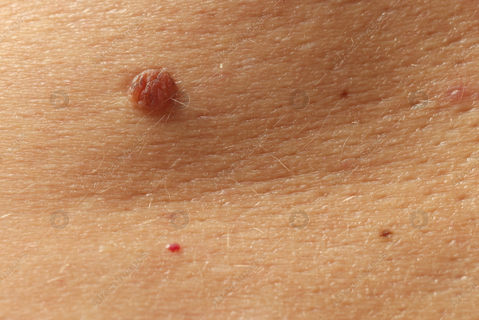 Man with moles on his skin, closeup Photo of Man with moles on his skin, closeup