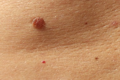 Photo of Man with moles on his skin, closeup