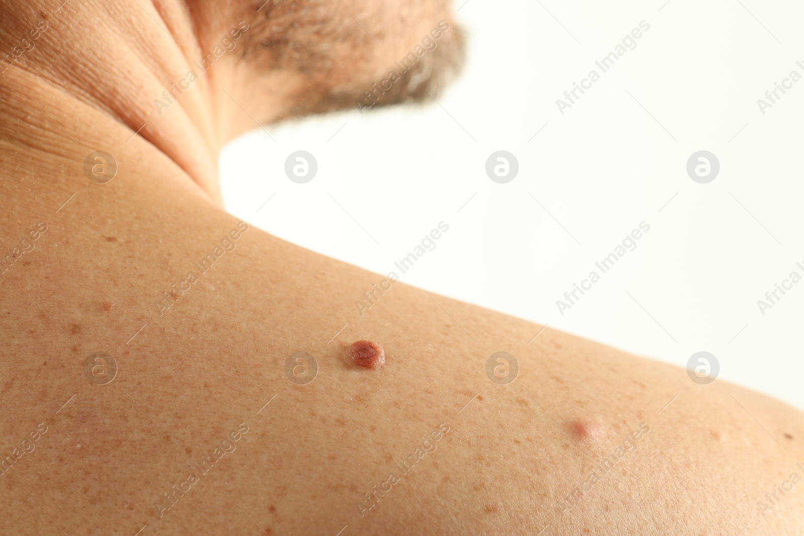 Man with mole on his skin against light background, closeup Photo of Man with mole on his skin against light background, closeup