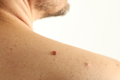Photo of Man with mole on his skin against light background, closeup