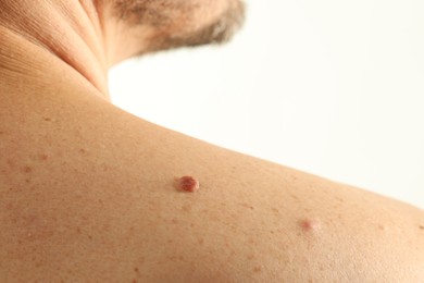 Photo of Man with mole on his skin against light background, closeup