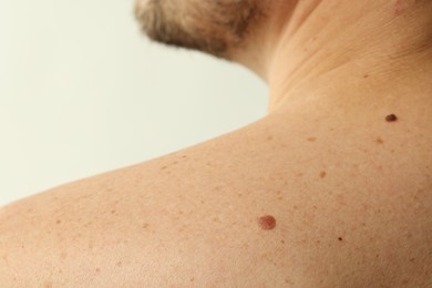 Photo of Man with mole on his skin against light background, closeup