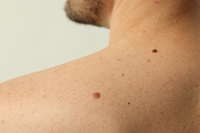 Photo of Man with mole on his skin against light background, closeup