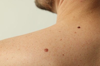 Photo of Man with mole on his skin against light background, closeup