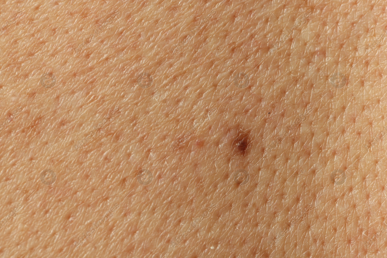 Man with mole on his skin, closeup Photo of Man with mole on his skin, closeup