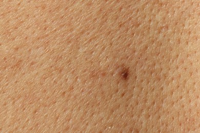Photo of Man with mole on his skin, closeup