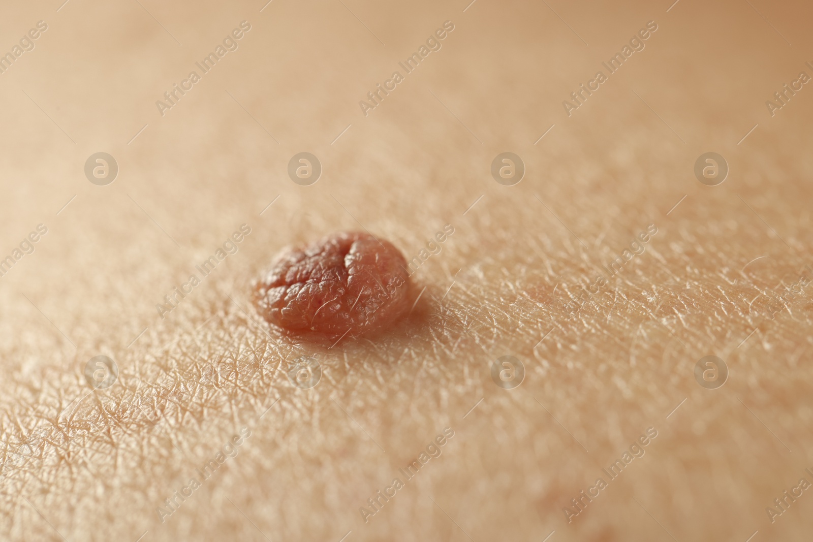 Man with mole on his skin, closeup Photo of Man with mole on his skin, closeup