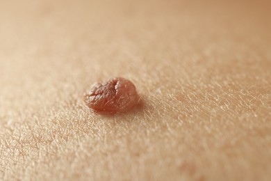 Photo of Man with mole on his skin, closeup
