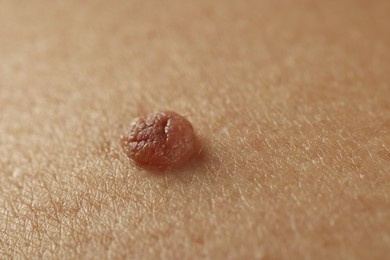 Photo of Man with mole on his skin, closeup