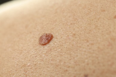 Photo of Man with mole on his skin, closeup
