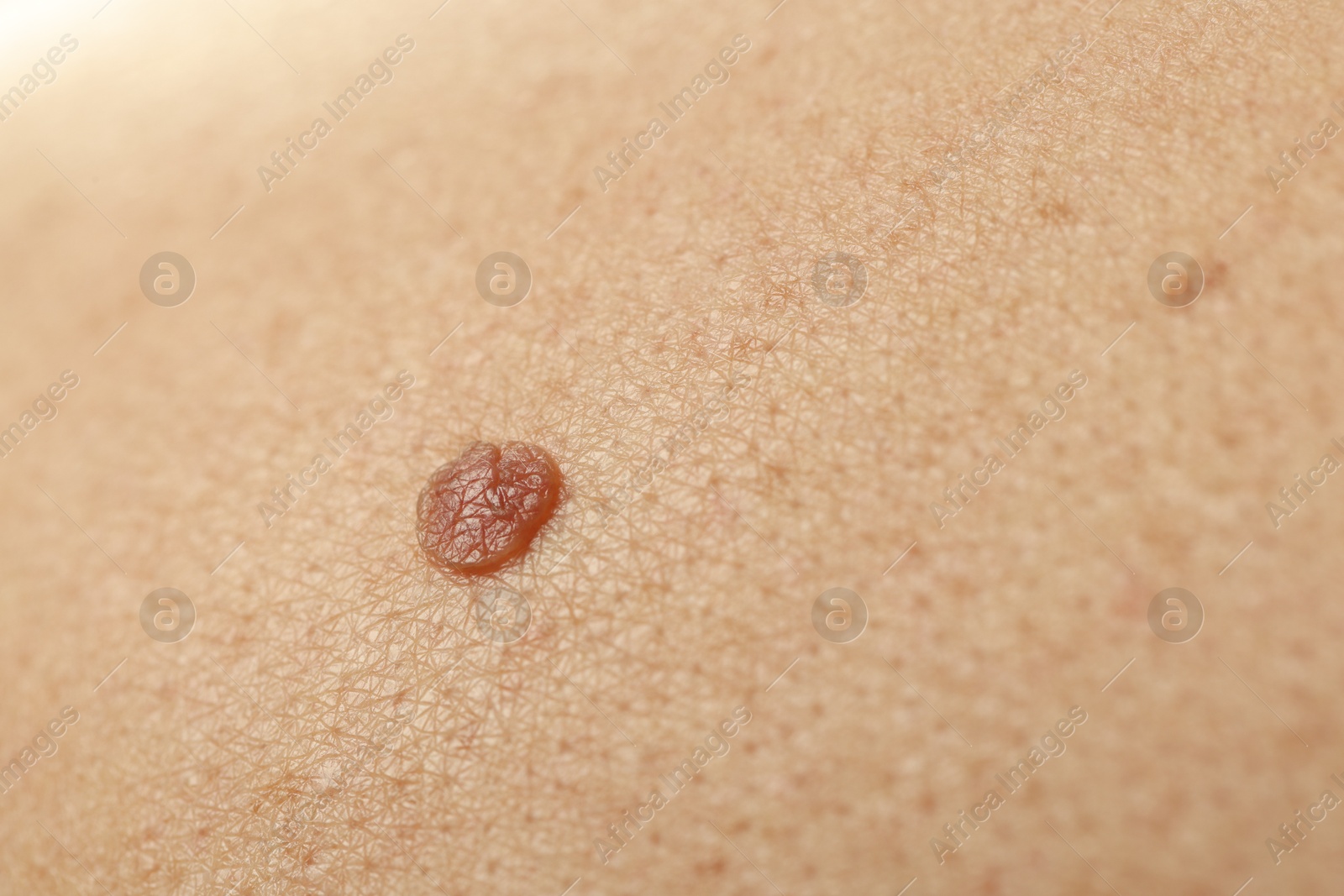 Man with mole on his skin, closeup Photo of Man with mole on his skin, closeup