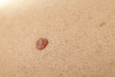 Photo of Man with mole on his skin, closeup