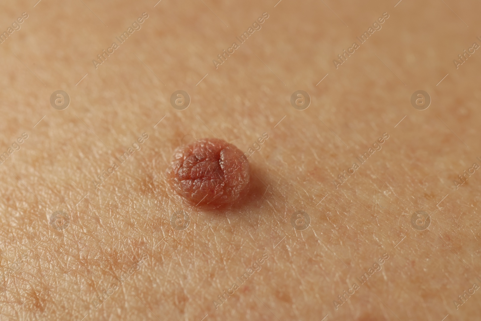 Man with mole on his skin, closeup Photo of Man with mole on his skin, closeup