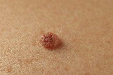 Photo of Man with mole on his skin, closeup