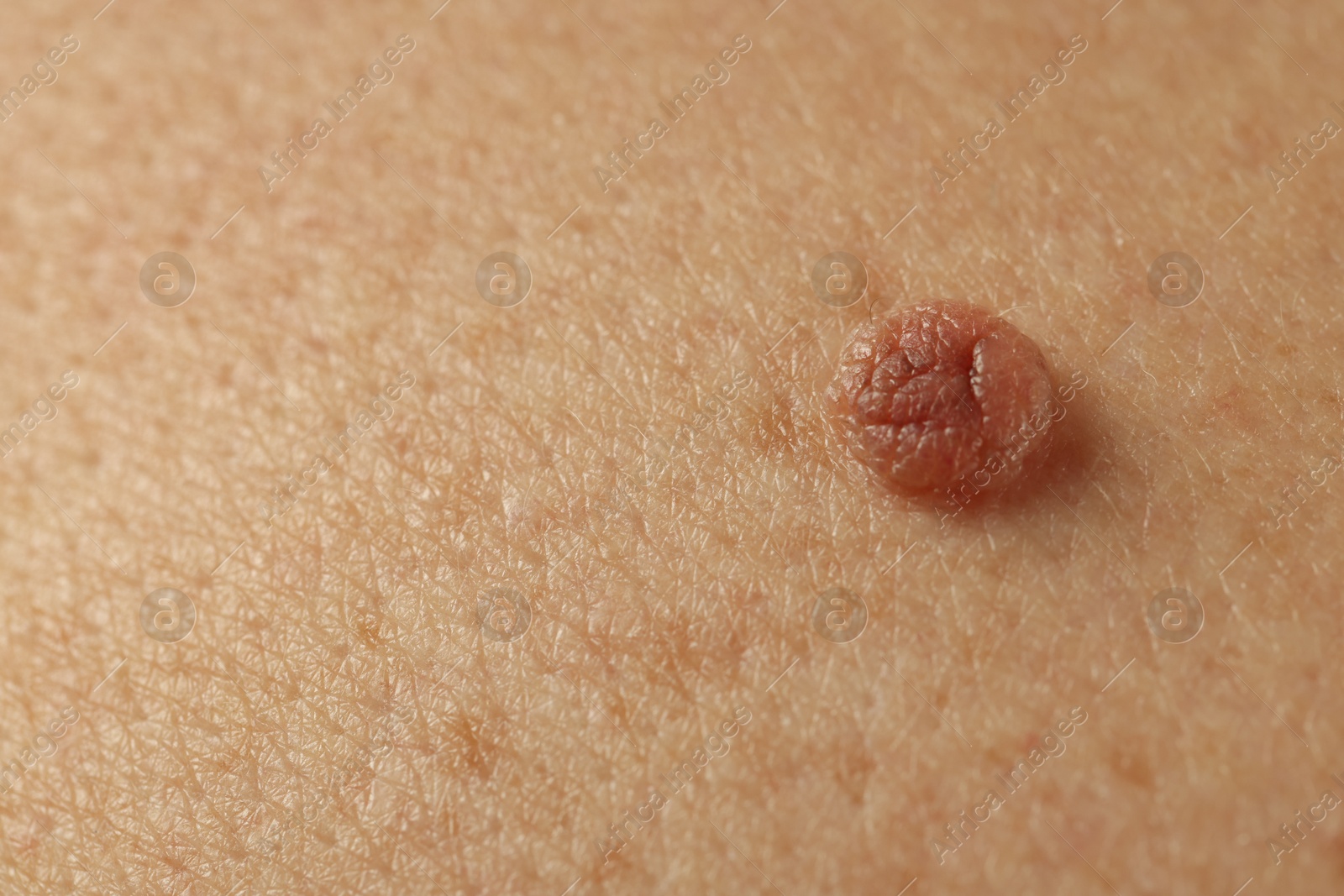 Man with mole on his skin, closeup Photo of Man with mole on his skin, closeup