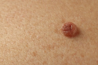 Photo of Man with mole on his skin, closeup