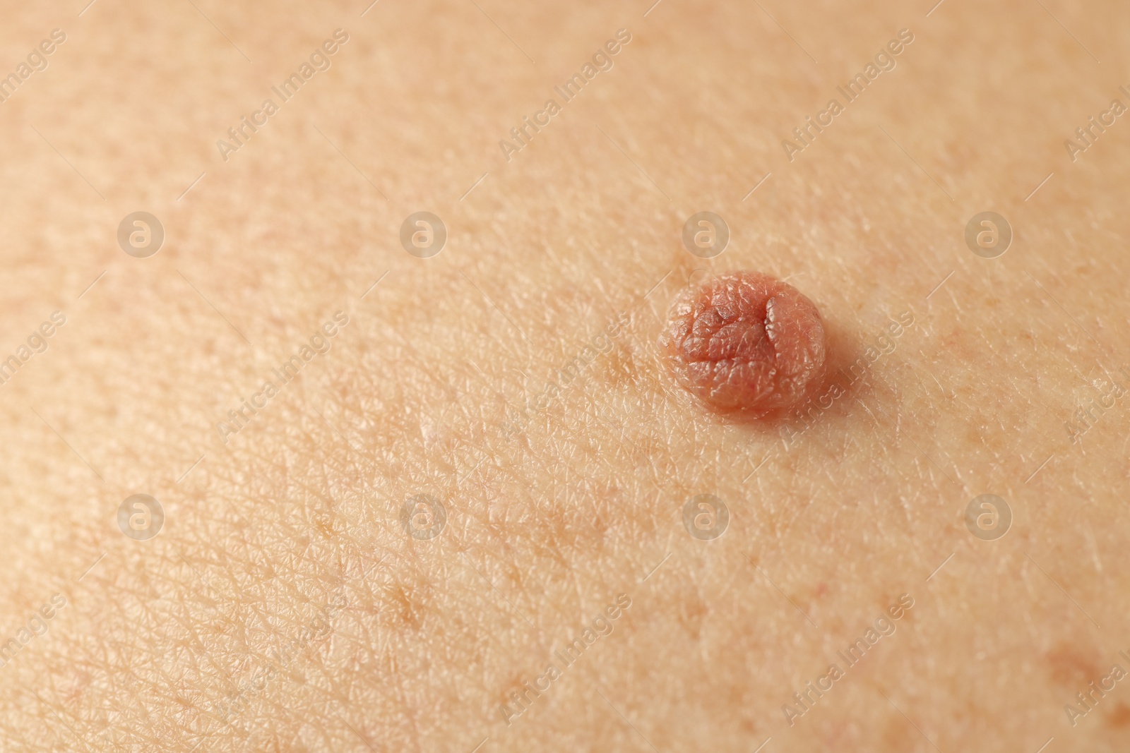 Man with mole on his skin, closeup Photo of Man with mole on his skin, closeup